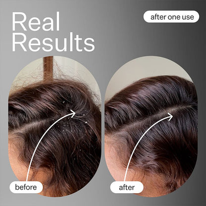 Act+Acre Salicylic Acid Scalp Exfoliator Serum