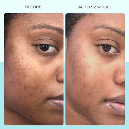 First Aid Beauty Dark Spot Serum with Niacinamide Discontinued
